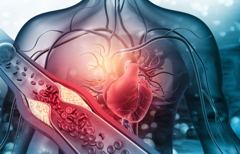 Heart-arteries-clogged