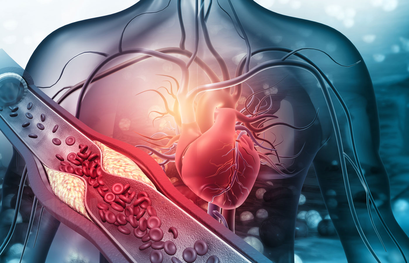 Heart-arteries-clogged
